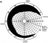 Monocular Visual Field rt. eye.jpg